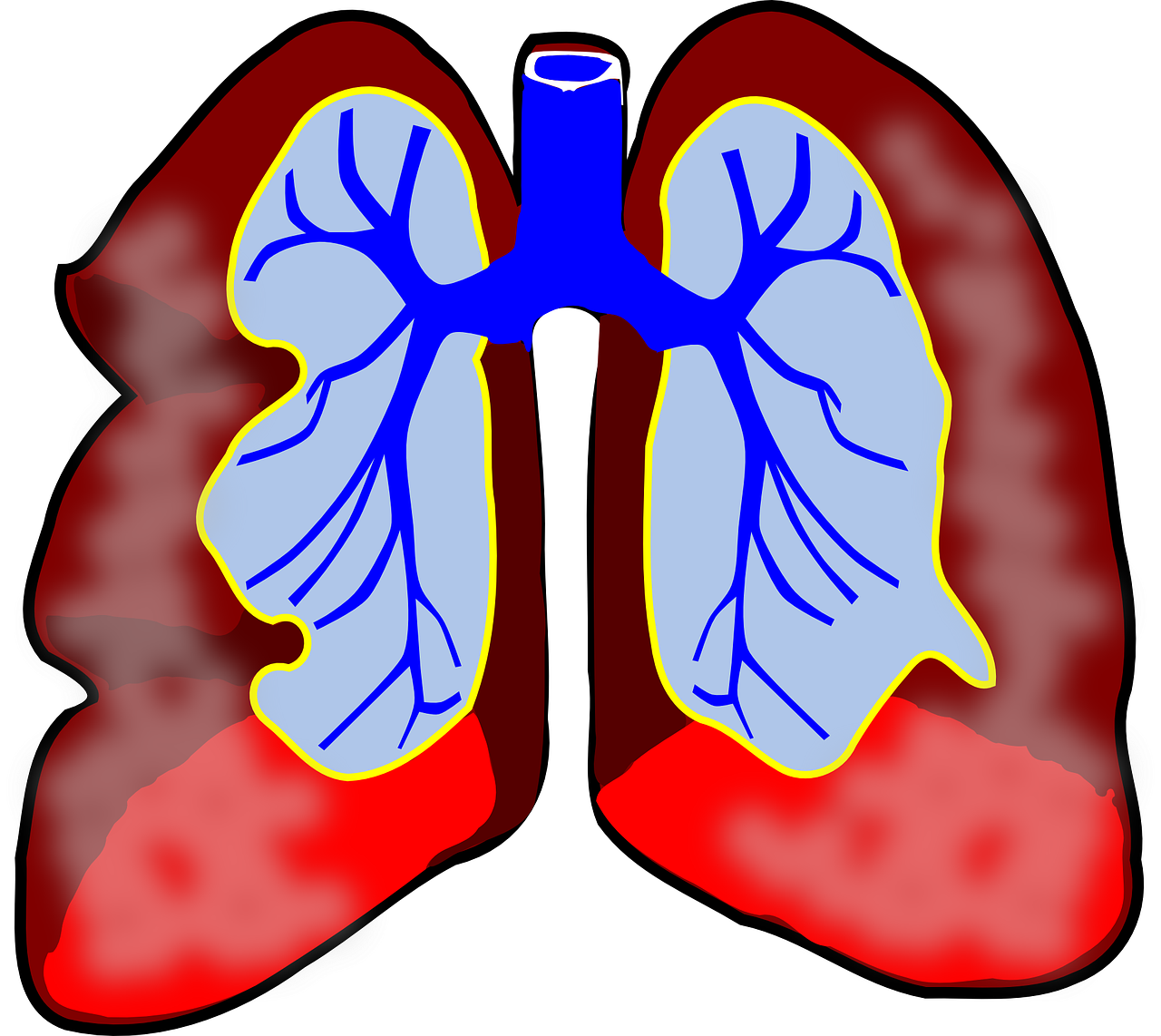 Hạt điều cải thiện bệnh lao, viêm phổi